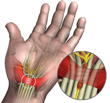 Carpal tunnel syndrome - London Elbow Surgeon