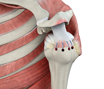 Shoulder Specialist South Cheshire  Shoulder Joint Surgery Stafford,  Staffordshire